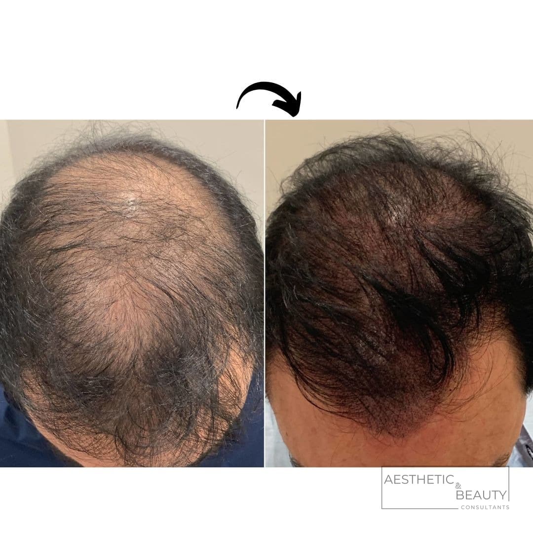 Hair restoration — before and after