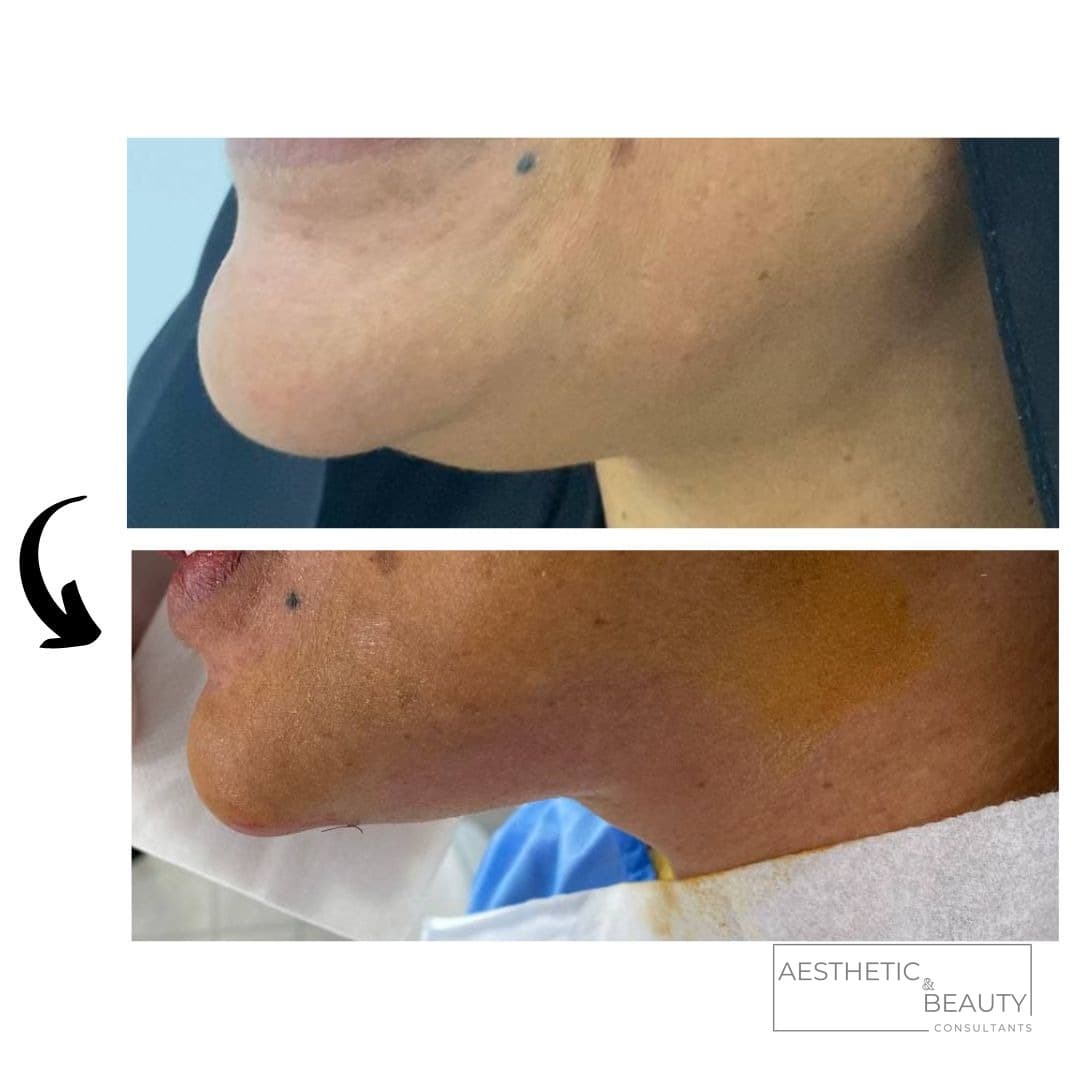 Jawline & chin — before and after