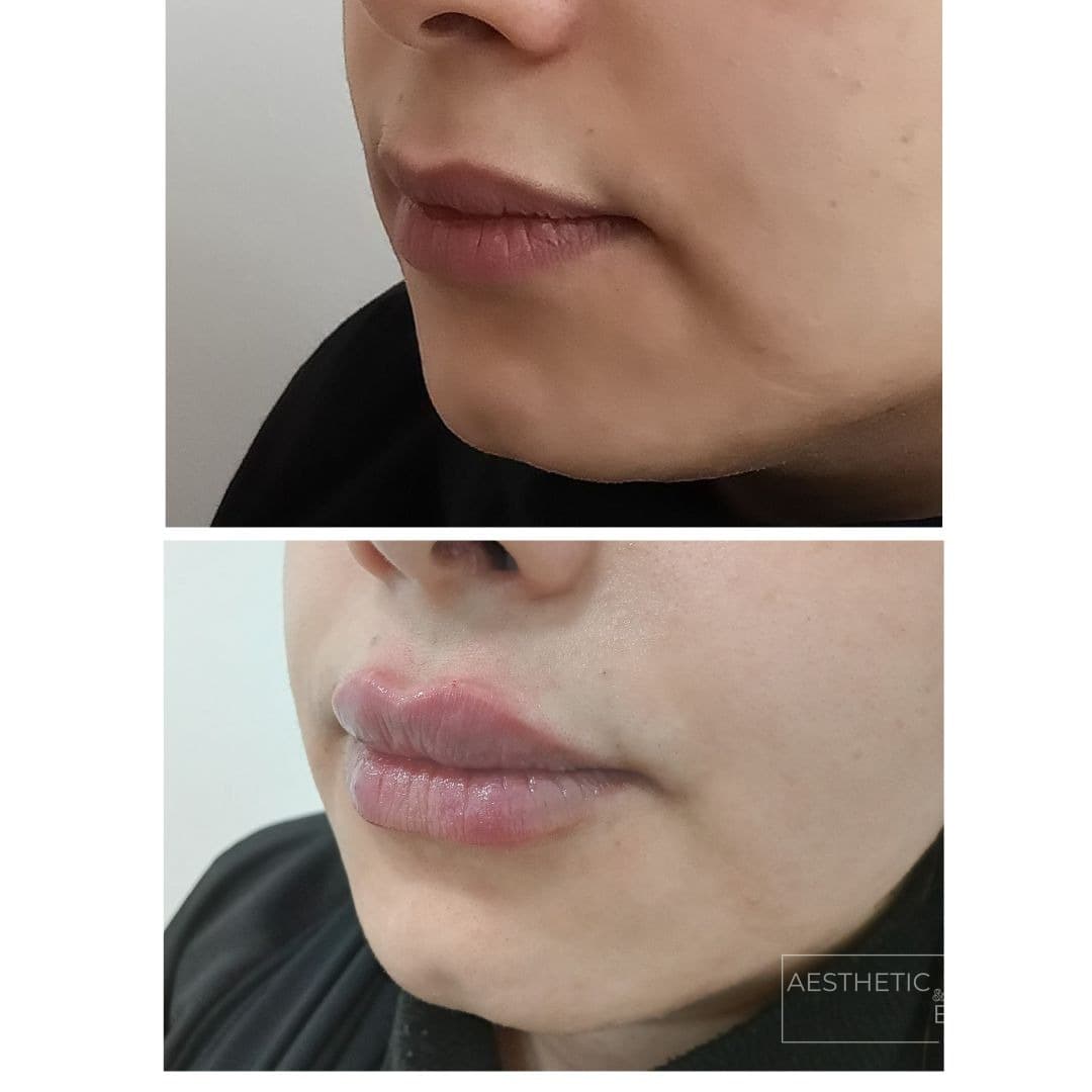 Lip filler — before and after