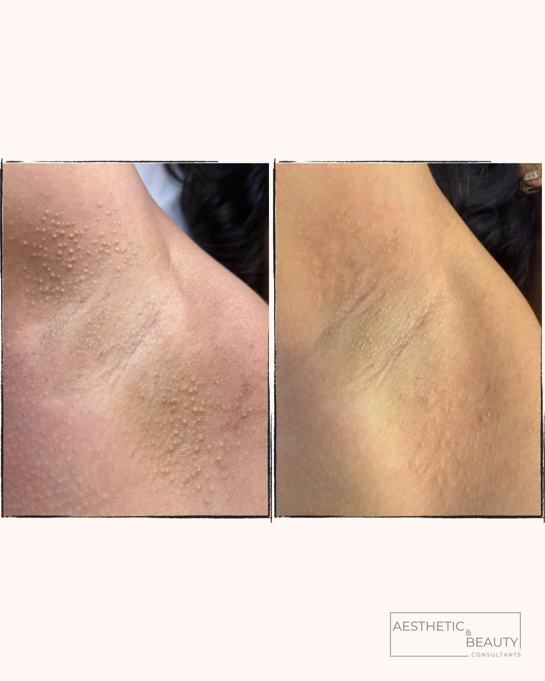 Skin & texture — before and after