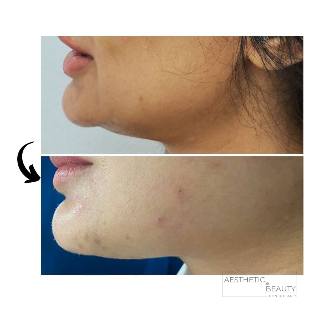Chin & jawline — before and after