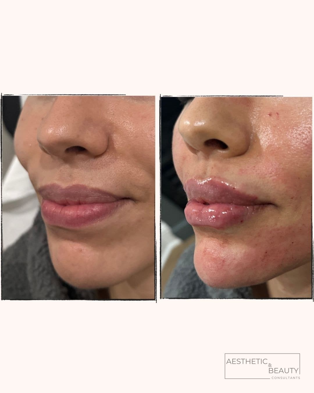 Lip definition — before and after