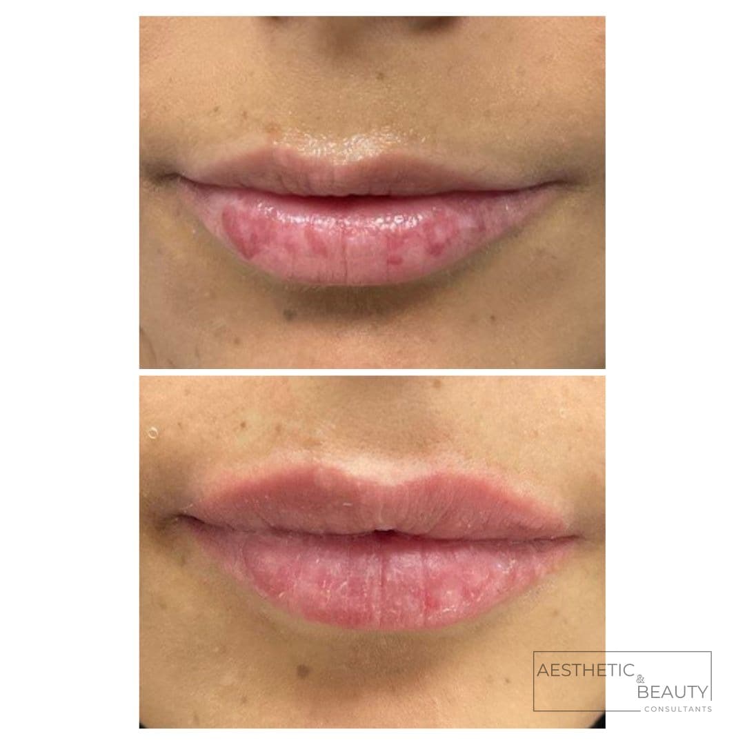 Lip enhancement — before and after