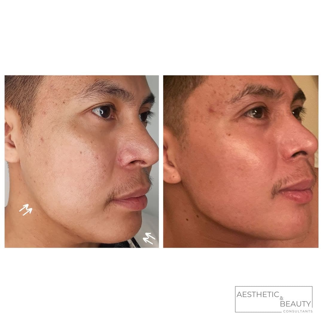 Jaw & cheek definition — before and after